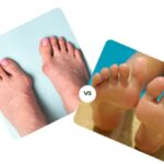 Hyggear Bunion Corrector