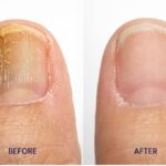 STRIDE Toenail Fungus