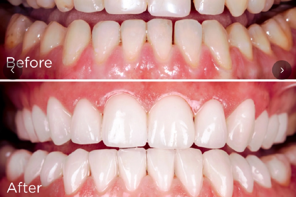 EVO Purple Toothpaste Review - Does It Really Whiten Teeth? - The Maker ...