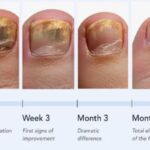 Viva Harbor Antifungal Pen